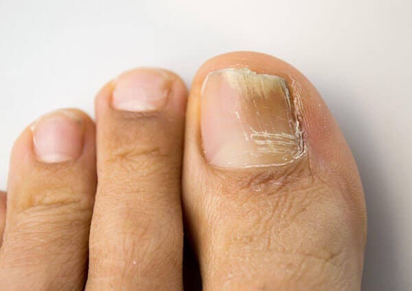 Common toenail fungus