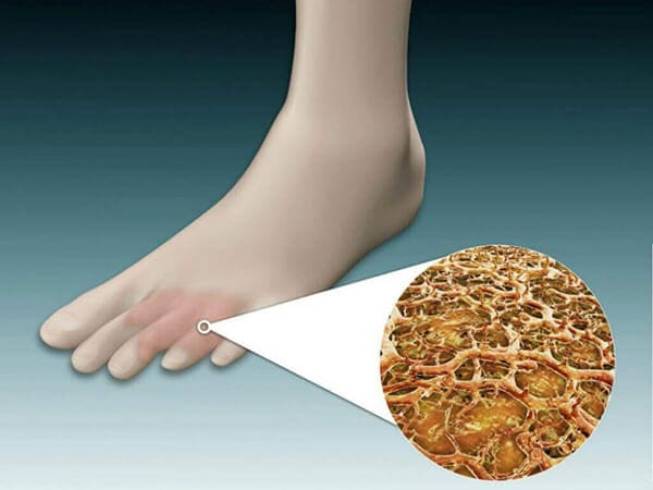 Fungi on tissue