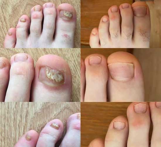 Healthy nails with Orivelle